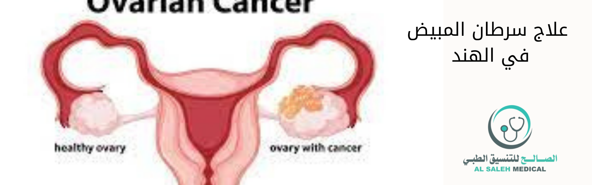 علاج سرطان المبيض في الهند| الأسباب والتكاليف